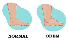 VÜCUTTA OLUŞAN ÖDEMİN SEBEPLERİ