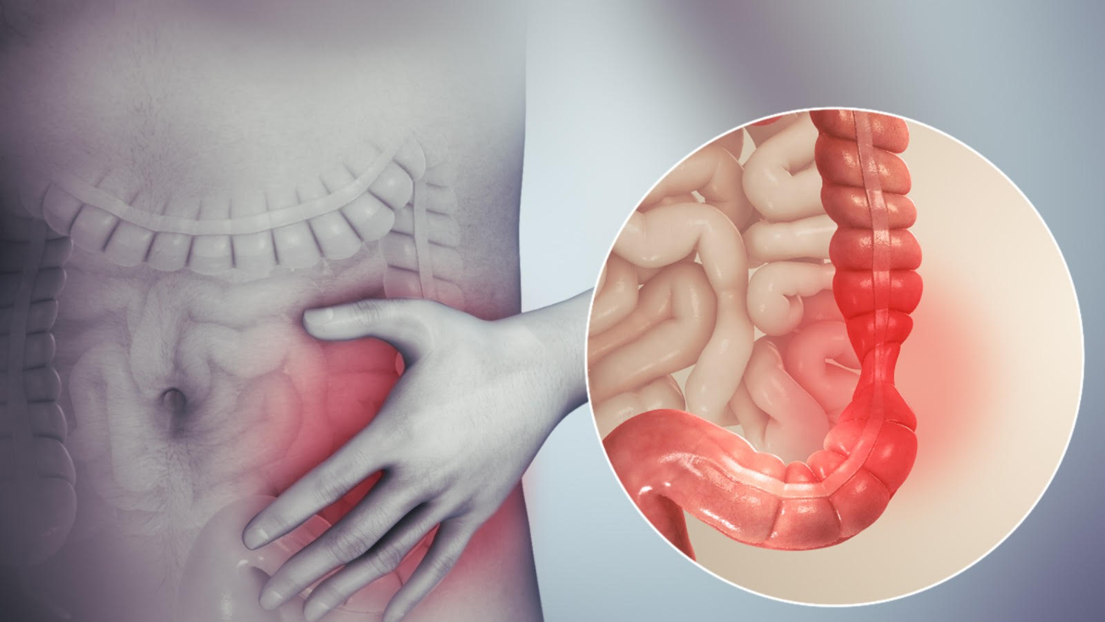 IBS (İrritabl Bağırsak Sendromu) ve Beslenme Süreci