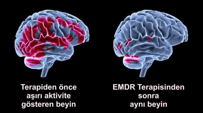 ​​​​​​​EMDR NEDİR?